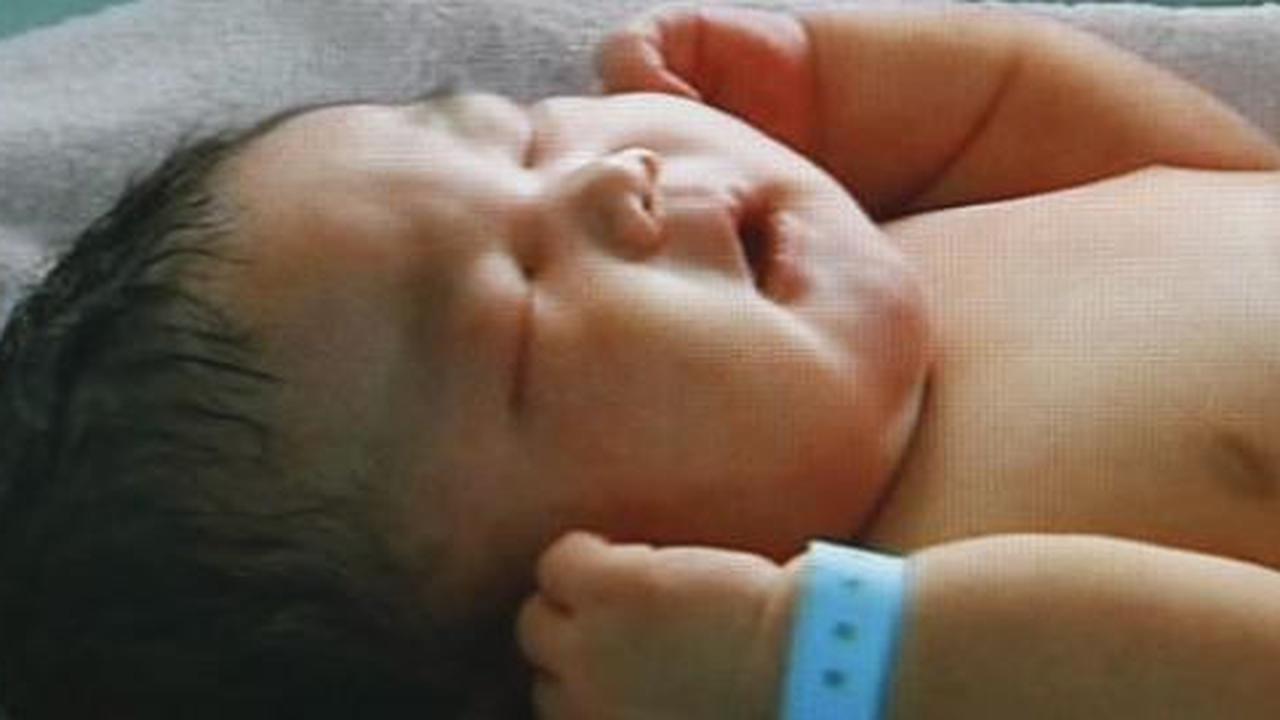 Bayi kembar dempet dada-perut lahir di Bali