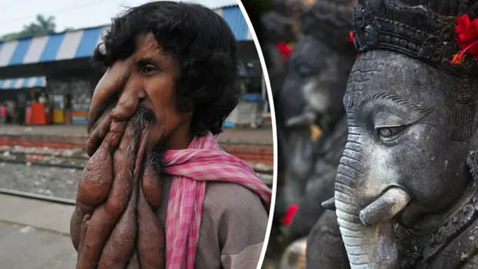 Miliki Belalai Seperti Gajah, Pengemis Ini Dianggap Dewa