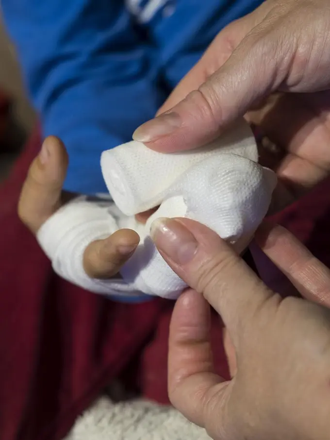 6 Cara Menangani Luka pada Anak Menurut Dokter Spesialis Anak Mesty Ariotedjo