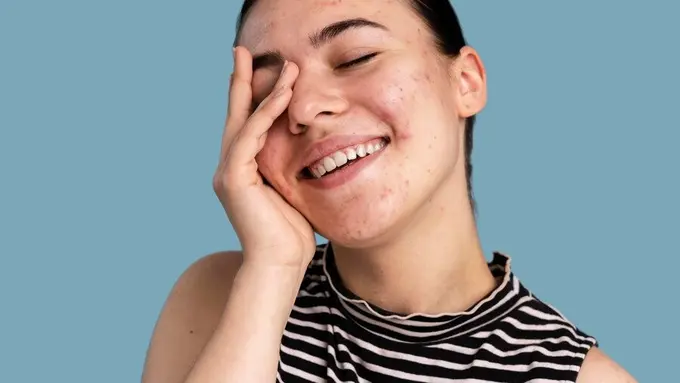 Tips untuk Kulit Berjerawat Tetap Bisa Pakai Makeup (Foto/Sumber: Freepik)