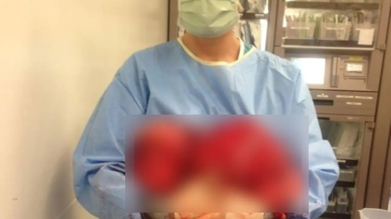 Perut Marcey DiCaro Membesar karena Ada Tumor 21,5 Kg