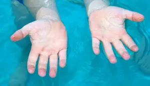 Jari Keriput Setelah Berenang Ternyata Bukan Karena Menyerap Air