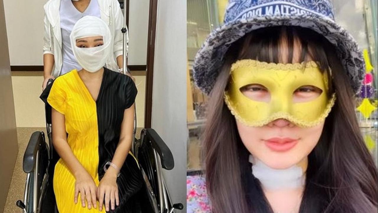 Beda Penampilan 5 Seleb Wanita Tanah Air Jalani Operasi Plastik saat Diperban Vs Setelahnya