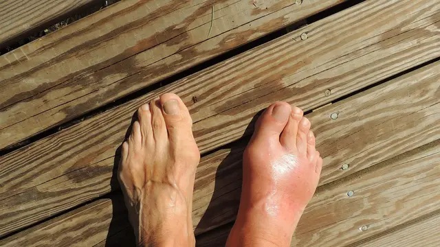 cara menurunkan asam urat