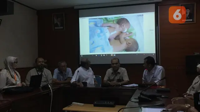 Bayi Kembar Siam