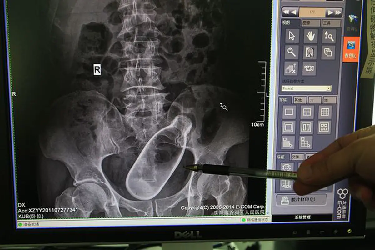 Foto Rontgen Perlihatkan Botol dalam Anus Pria
