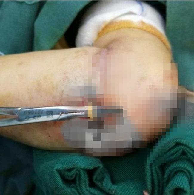 Operasi dilakukan demi mengambil karet gelang yang menyatu ke kulitnya/copyright worldofbuzz.com/Seehua