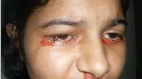 Preeti Gupta mengalami hal aneh saat menangis. Bukannya air, tapi darah yang keluar dari matanya.