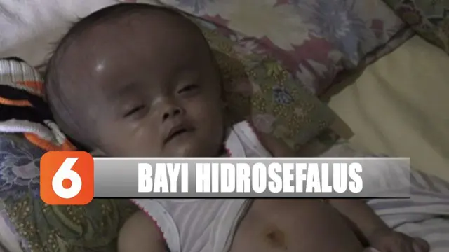 Bayi berumur 10 bulan di Nganjuk, Jawa Timur sejak di dalam kandungan menderita hidrosefalus.