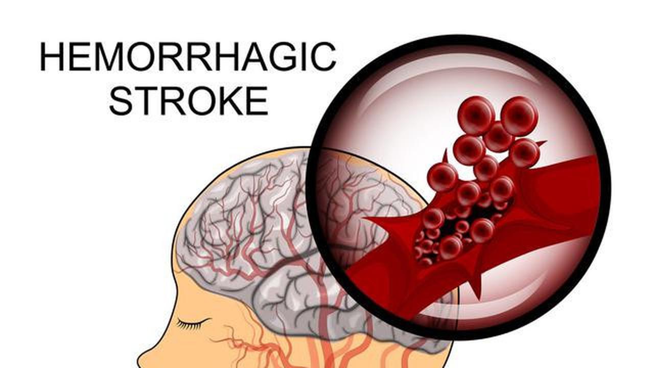 Kenali Risiko Stroke Sejak Dini, Begini Gejala dan Cara Penanganannya