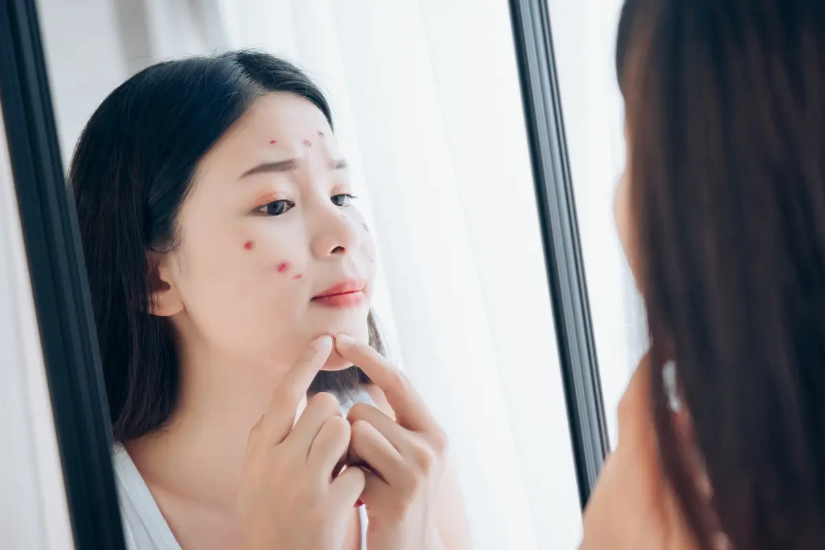 Jenis Jerawat Serta Cara Mengatasinya