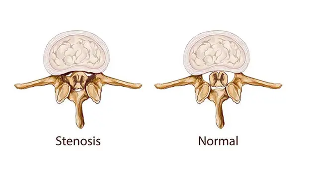Waspada Nyeri Pinggang dan Saraf Terjepit karena Stenosis Spinal, Bagaimana Metode Penyembuhan yang Tepat?