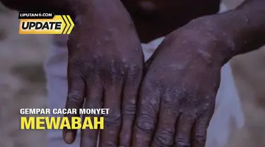 WHO menetapkan cacar monyet atau monkeypox sebagai Public Health Emergency of International Concern (PHEIC) atau darurat kesehatan global. Lalu, negara tetangga Singapura pun sudah ada 10 kasus. Meski sampai saat ini belum ada kasus, Ikatan Dokter In...