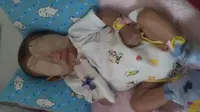 Katarak dan Tuli, Bayi Qiandra Melawan Rubella dalam Sunyi