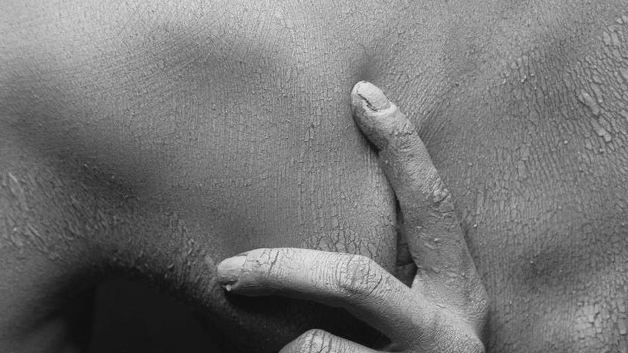 Ketahui Tentang Psoriasis Vulgaris, Gejala dan Cara Mengobatinya