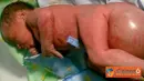 Citizen6, Semarang: Seorang bayi berjenis kelamin perempuan yang dilahirkan keluarga kurang mampu di RSUP Dr Kariadi Semarang mempunyai benjolan berisi cairan sumsum tulang belakang. (Pengirim: Mithcelle Carvin)