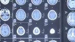 Apa yang terjadi pada wanita ini sungguh menyeramkan. Menyangka ada tumor, ternyata ada hal mengerikan dalam otaknya. 