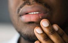 Cara Penularan Herpes yang Wajib Diwaspadai, Begini Pencegahannya