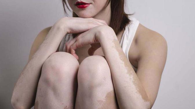 4 Ramuan Alami Atasi Pudarnya Warna Kulit Akibat Vitiligo Health