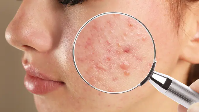 Memiliki Jerawat Hormon? Hindari Mengonsumsi Makanan Ini!