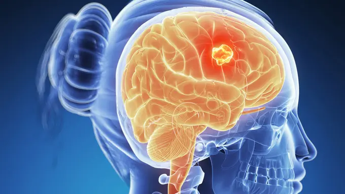4 Fakta Soal Kanker Otak yang Mungkin Belum Kamu Tahu