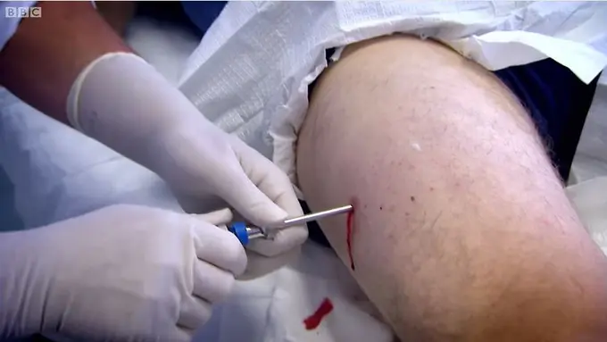 Ngeri! Usai Biopsi, Pria Ini Asyik Nikmati Dagingnya Sendiri!