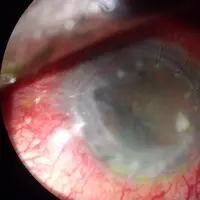 Mau tahu apa yang terjadi jika kamu selama 5 bulan selalu pakai softlens? (Ilustrasi: sclerallens.com)