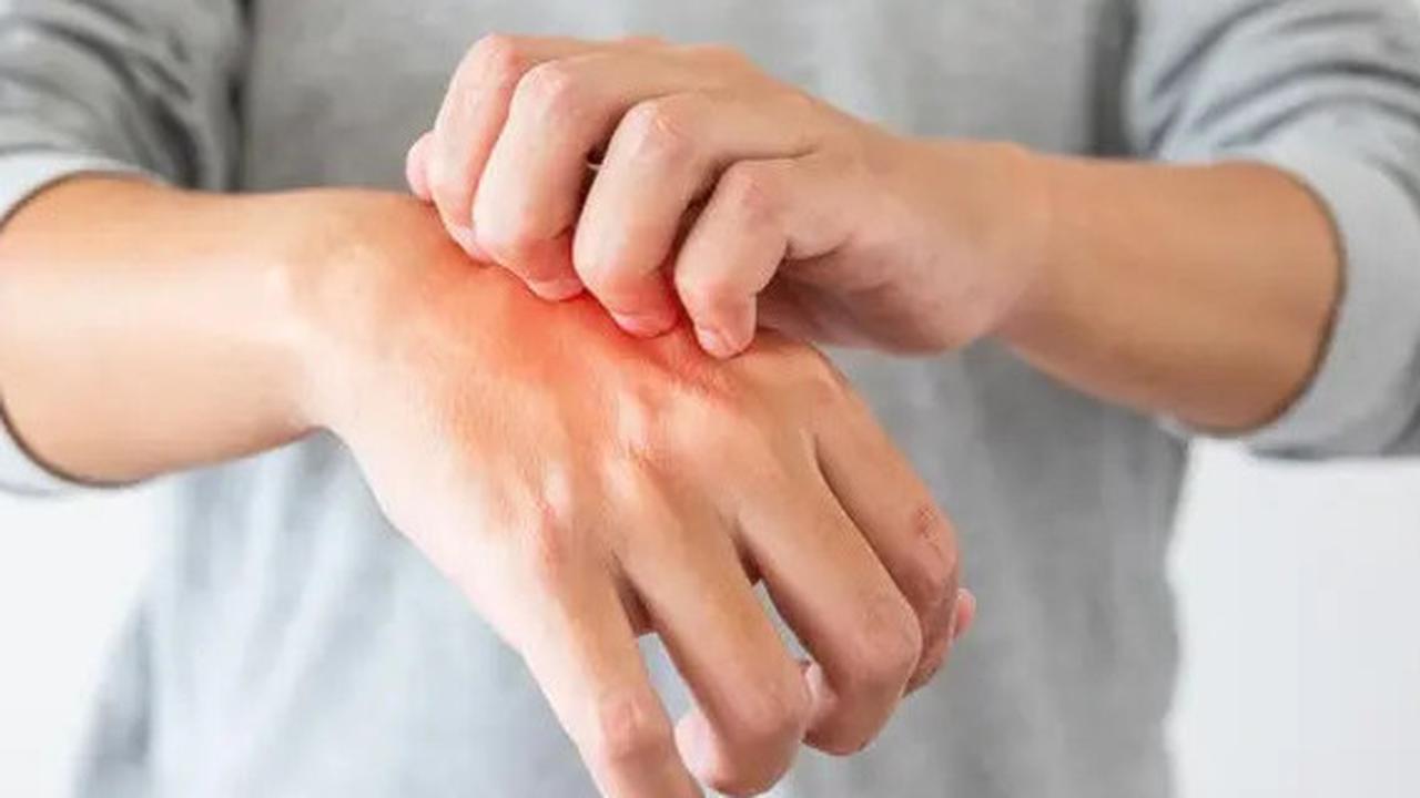 Cara Ampuh Mengatasi Eksim dan Mencegah Kambuh Kembali