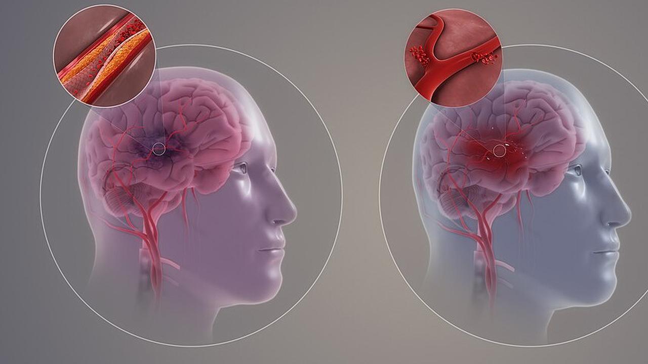 Jangan Panik Saat Stroke Terjadi: Langkah-Langkah Pertolongan Pertama yang Wajib Diketahui