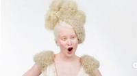 Cerita Wanita Albino Xueli Abbing Pernah Dibuang di Panti Asuhan Kini Jadi Model Terkenal. (dok.Instagram @flaviadutradermato/https://www.instagram.com/p/COTE8NAF5H4/Henry)