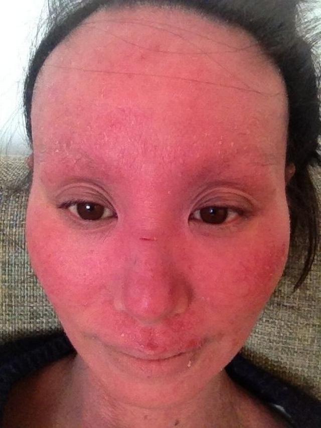 Kisah Perjuangan Wanita Atasi Eksim Hingga Membuat Wajahnya Berubah Ini Bikin Pilu