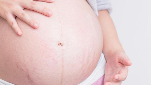 Cara Mudah Cegah Stretch Mark Saat Hamil