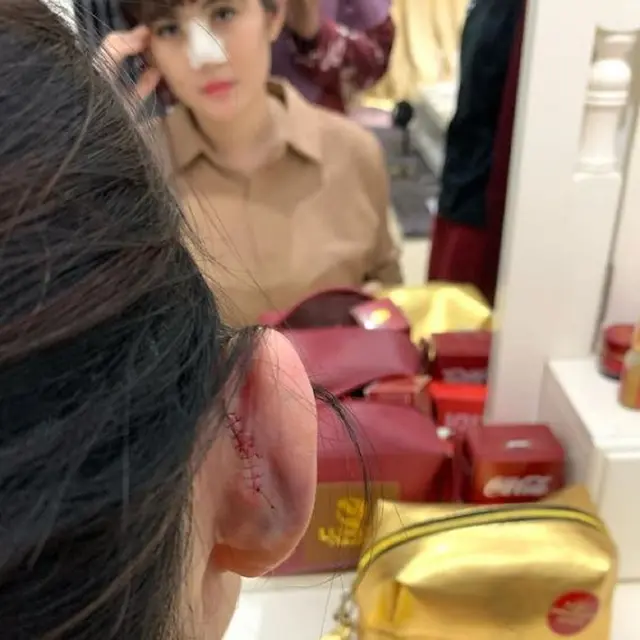 Angela Lee menyesal dan kapok telah menjalani operasi hidung