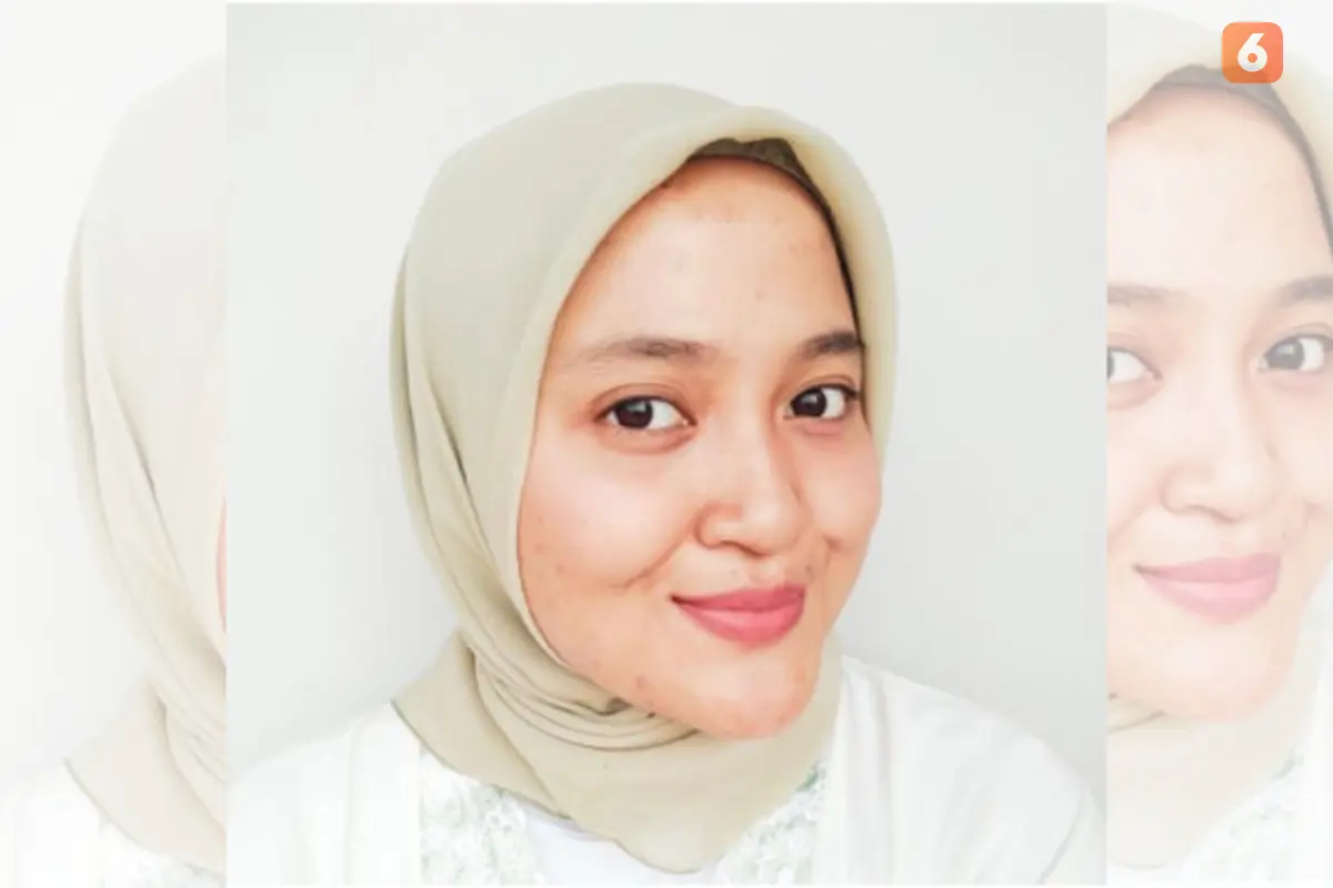 Nimas Mita Pasien Kanker Tulang atau Osteosarkoma.