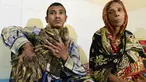 Abul Bajandar (26) mengalami kutil berlebihan yang membuatnya tampak seperti manusia akar, di Dhaka Medical College dan Rumah Sakit, Bangladesh, Minggu (31/1). Bajandar mengaku penyakitnya pertama kali muncul pada 10 tahun lalu. (AFP Photo/Munir uz ZAMAN)