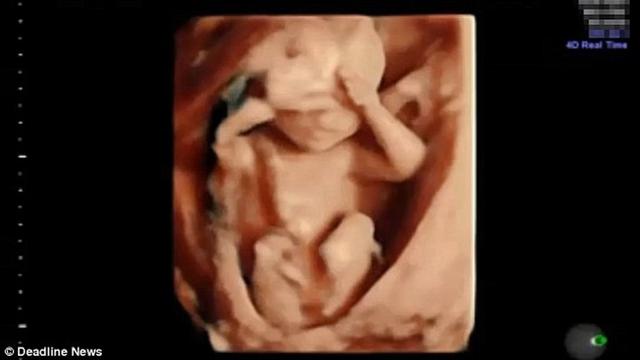 Menakjubkan Rekaman Usg Bayi Bermain Cilukba Global Liputan6 Com