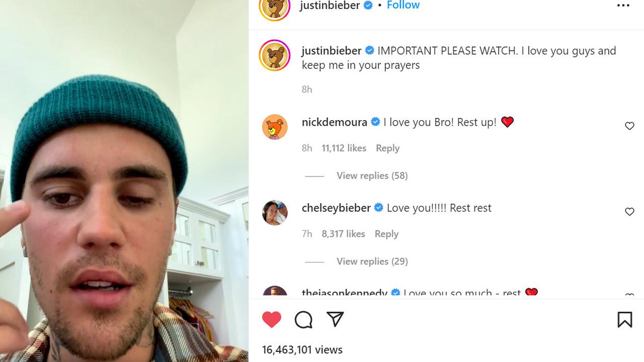 Justin Bieber alami Ramsay Hunt Syndrome yang membuat wajah lumpuh sebelah. (Foto: Potongan layar Instagram @justinbieber)