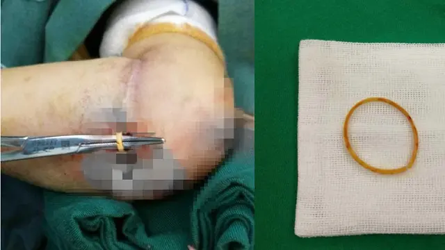 Gunakan Karet Gelang, Balita Justru Alami Bengkak Parah