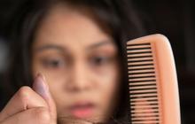 Cari Tahu Apa Saja Penyebab Kebotakan Rambut di Usia Muda, Nomor 3 Paling Sering Dilakukan!