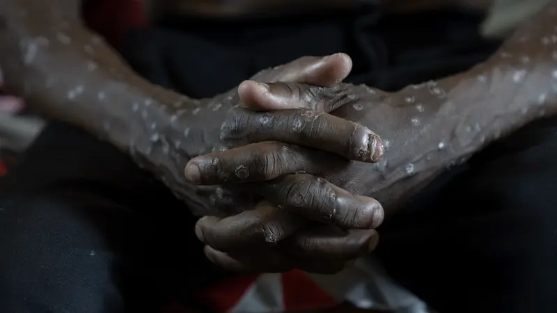 Mpox di Kongo