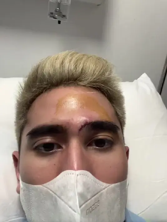 Verrell Bramasta saat menjalani proses jahitan karena alisnya robek akibat terbentur sangat keras. (Instagram @bramastavrl) - 4