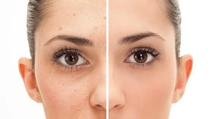 Ini 5 Hal Sepele yang Bisa Bikin Bekas Jerawat Susah Hilang