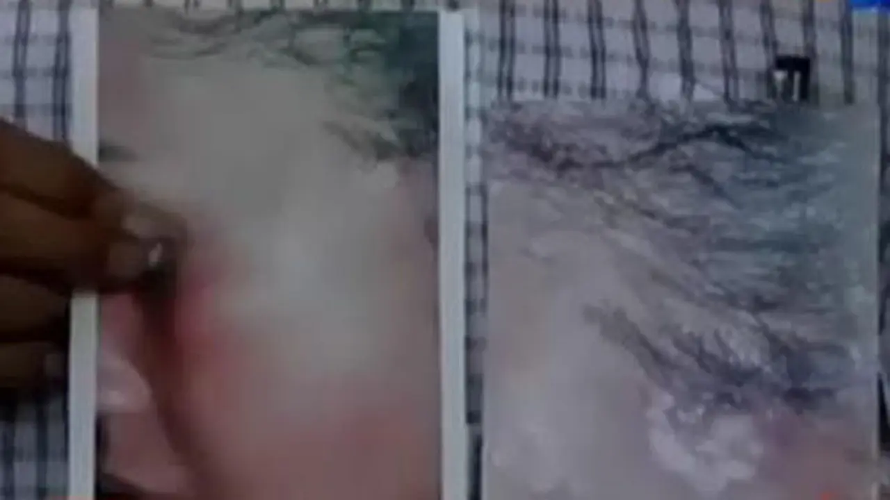 VIDEO: Dugaan Malapraktik, Pipi Wanita Ini Terus Keluar Cairan