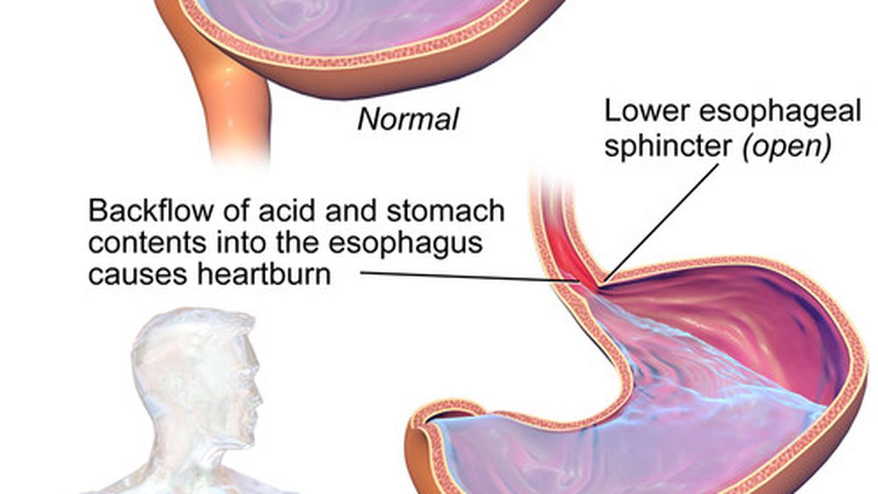 Ilustrasi Heartburn