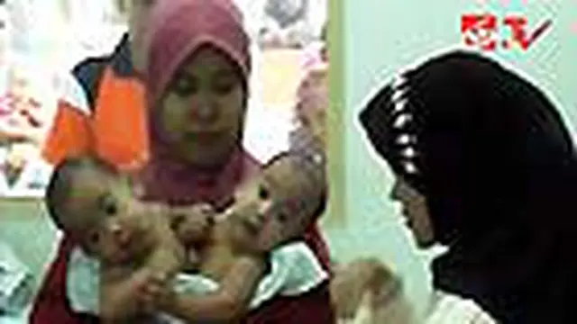 Kembar Siam Rafa-Rafi Dipisahkan