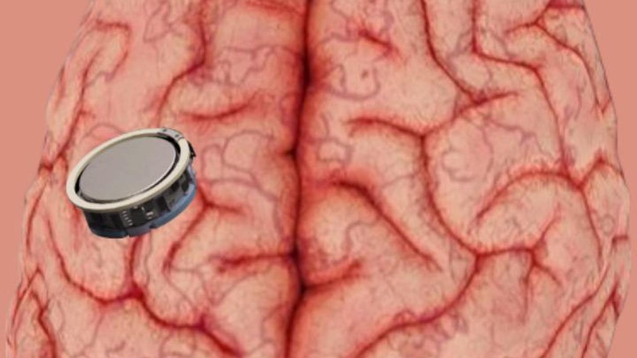 Perusahaan Punya Elon Musk Ini Lagi Cari Relawan Tanam Chip di Otak, Begini Syaratnya