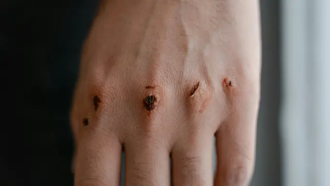 Cara Menyembuhkan Keloid dengan Aman dan Efektif