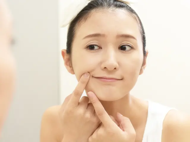 5 Alternatif Cara Mengobati Jerawat Di Area Rahang Ketika Menstruasi Beauty Fimela Com