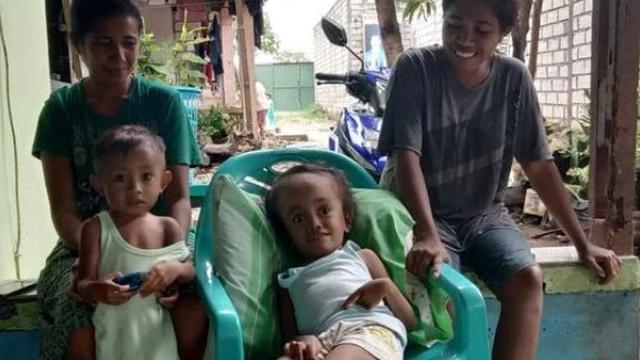 Bocah penderita hidrosefalus