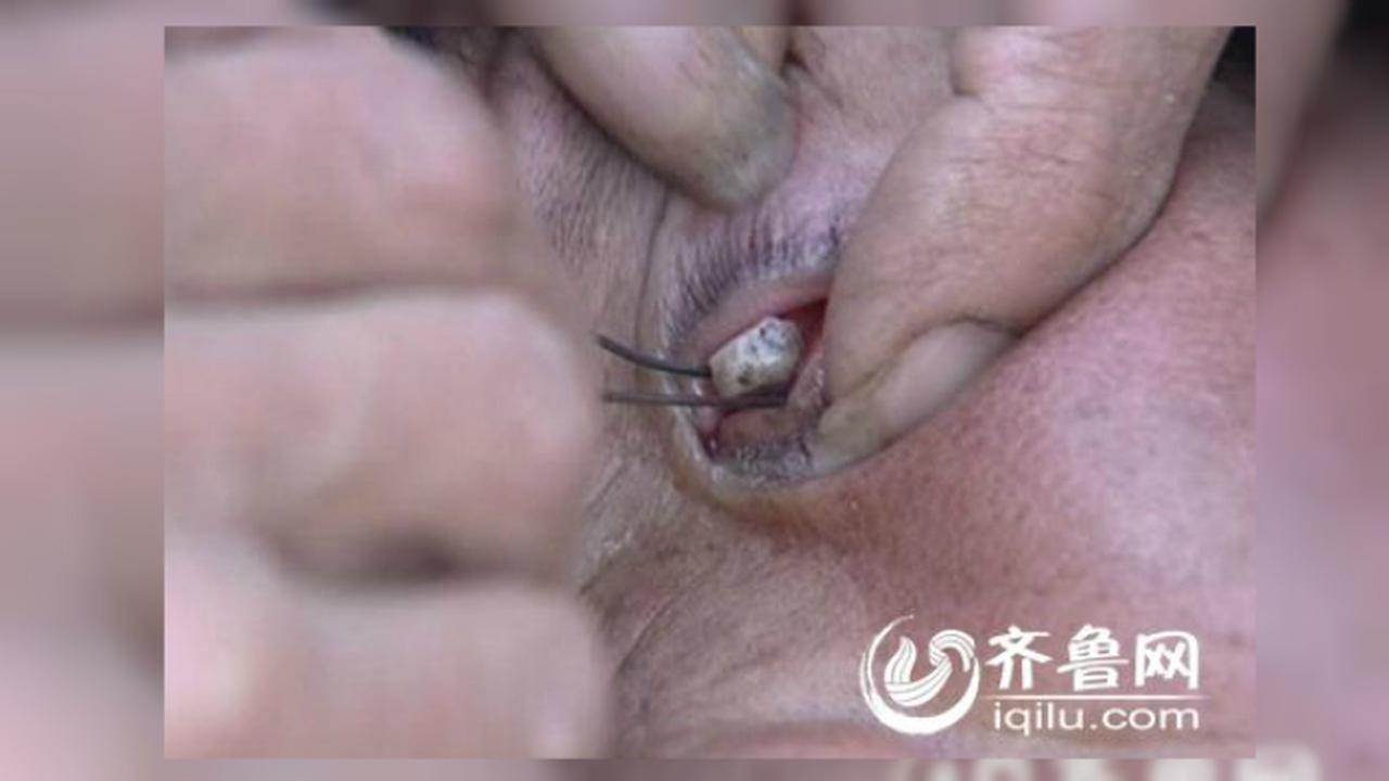 Batu Kerikil Sebesar Biji Kedelai Tumbuh di Mata Perempuan Ini